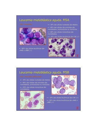Leucemia mieloblástica aguda. M5A
M5A - Monocítica
      Monocí                            • ≥ 30% das células nucleadas são blastos.
                                                    cé                sã
                                        • ≥ 80% das células não eritróides são
                                                    cé      nã eritró      sã
                                        monoblastos, promonócitos ou monócitos.
                                                     promonó           monó
                                        • ≥ 80% das células monocíticas são
                                                     cé     monocí      sã
                                        monoblastos.
                                        • < 20% das células leucêmicas são CAE (+)
                                                    cé      leucê      sã




• ≥ 80% das células leucêmicas são
            cé      leucê      sã
αNAE e αNBE (+).




Leucemia mieloblástica aguda. M5B
M5B – Monocítica Diferenciada
      Monocí

 • ≥ 30% das células nucleadas são blastos.
             cé                sã
 • ≥ 80% das células não eritróides são
             cé      nã eritró      sã
 monoblastos, promonócitos ou monócitos.
              promonó           monó
 • < 80% das células monocíticas são
              cé     monocí      sã
 monoblastos.




                                       • < 20% das células leucêmicas são CAE (+)
                                                   cé      leucê      sã
                                       • ≥ 80% das células leucêmicas são αNAE e
                                                   cé      leucê      sã
                                       αNBE (+).
 