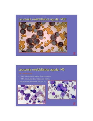 Leucemia mieloblástica aguda. M5B




                                                   Cloracetato + α naftil butirato esterase




Leucemia mieloblástica aguda. M6
M6 - Eritroleucemia
• ≥ 50% das células nucleadas são eritroblastos.
            cé                sã
• ≥ 30% das células não eritróides são blastos.
            cé      nã eritró      sã
• Muitas células precursoras são PAS (+).
         cé                  sã
 