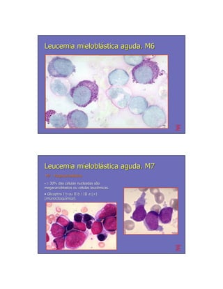 Leucemia mieloblástica aguda. M6




                                          PAS




Leucemia mieloblástica aguda. M7
M7 - Megacarioblástica
     Megacarioblá

•≥30% das células nucleadas são
            cé                 sã
megacarioblastos ou células leucêmicas.
                    cé      leucê
• Glicoptns I b ou II b / III a (+)
(imunocitoquímica).
(imunocitoquí
 