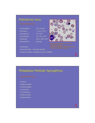 Policitemia Vera.
Aspectos laboratoriais


• Hemoglobina              18 a 24 g/dl
• Hemácias
  Hemá                     7 a 10 x 1012/l
• Hematócrito
  Hemató                   70 a 92%
• Leucometria              25 a 50 x 109/l
• Plaquetas                500 a 1000 x109/l
• Reticulócitos
  Reticuló                 Normais
                                               Poiquilocitose, anisocitose, presença de
                                                                            presenç
                                               precursores eritróides,
                                                            eritró
• Anisocitose                                  aumento de neutrófilos, basófilos e plaquetas.
                                                            neutró       basó
                                               Aumento do número de hemácias.
                                                            nú           hemá
• Policromatofilia – Ponteado basófilo.
                              basó
• Aumento relativo e absoluto da série mielóide.
                                 sé mieló




Metaplasia Mielóide Agnogênica.
Características Clínicas
Caracterí       Clí


• Anemia.
• Esplenomegalia.
• Hepatomegalia.
• Leucocitose.
• Trombocitose.
• Perda de peso.
• Sangramentos.
 