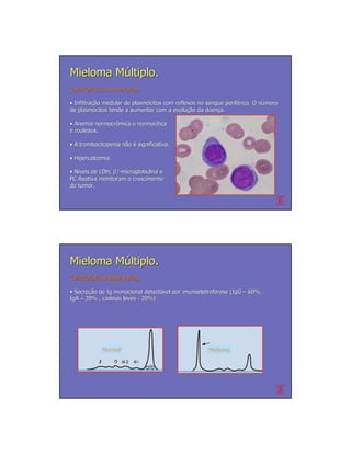 Mieloma Múltiplo.
Características laboratoriais
Caracterí

• Infiltração medular de plasmócitos com reflexos no sangue periférico. O número
  Infiltração            plasmó                             perifé        nú
de plasmócitos tende a aumentar com a evolução da doença.
    plasmó                              evolução     doenç

• Anemia normocrômica e normocítica
          normocrô      normocí
e rouleaux.

• A trombocitopenia não é significativa.
                    nã

• Hipercalcemia.

• Niveis de LDH, β2-microglobulina e
                 β2-
PC Reativa monitoram o crescimento
do tumor.




Mieloma Múltiplo.
Características laboratoriais
Caracterí

• Secreção de Ig monoclonal detectável por imunoeletroforese (IgG – 60%,
  Secreção                   detectá
IgA – 20% , cadeias leves - 20%)




             Normal                                  Mieloma
 