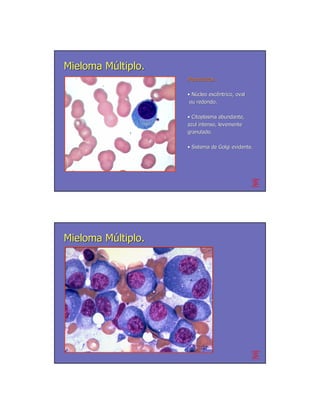 Mieloma Múltiplo.
                    Plasmócitos
                    Plasmó

                    • Núcleo excêntrico, oval
                             excê
                     ou redondo.

                    • Citoplasma abundante,
                    azul intenso, levemente
                    granulado.

                    • Sistema de Golgi evidente.




Mieloma Múltiplo.
 