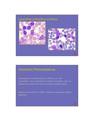 Leucemia Linfocítica Crônica.




Síndromes Mielodisplásicas.
Definição.
Definição.
São causadas por um defeito adquirido no DNA de um ou, mais
provavelmente, vários cromossomos do progenitor hemopoético (stem cell
               vá                               hemopoé
multipotente), podendo evoluir para uma leucemia mieloblástica aguda.
                                                 mieloblá


Etiologia.
Agentes químicos (benzeno), radiação / radioterapia, quimioterapia (agentes
        quí                 radiação
alquilantes).
 
