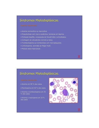 Síndromes Mielodisplásicas.
Aspectos Laboratoriais


• Anemia normocítica ou macrocítica.
         normocí        macrocí
• Poiquilocitose com macro-ovalócitos, hemácias em lágrima.
                     macro- ovaló      hemá        lá
• Ponteado basófilo, corpúsculos de Howell-Jolly e eritroblastos.
           basó      corpú          Howell-
• Contagem de reticulócitos normal ou baixa.
              reticuló
• Trombocitopenia ou trombocitose com macroplaquetas.
• Linfocitopenia, anomalia de Pelger-Huët.
                              Pelger- Huë
• Medula óssea hipercelular.




Síndromes Mielodisplásicas.
Aspectos Laboratoriais

• Anemia em 90 % dos casos.

• Pancitopenia em 50 % dos casos.

• Anemia e trombocitopenia em 25
% dos casos.

• Anemia e neutropenia em 10 %
dos casos.
 