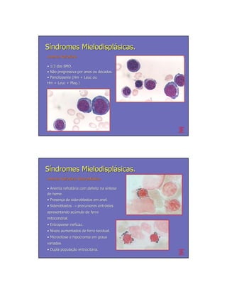 Síndromes Mielodisplásicas.
Anemia Refratária
       Refratá

• 1/3 das SMD.
• Não progressiva por anos ou décadas.
                              dé
• Pancitopenia (Hm + Leuc ou
Hm + Leuc + Plaq.)




Síndromes Mielodisplásicas.
Anemia Refratária Sideroblástica.
       Refratá Sideroblá

• Anemia refratária com defeito na síntese
         refratá                   sí
do heme.
• Presença de sideroblastos em anel.
  Presenç
• Sideroblastos → precursores eritróides
                              eritró
apresentando acúmulo de ferro
             acú
mitocondrial.
• Eritropoese ineficaz.
• Níveis aumentados de ferro tecidual.
• Microcitose e hipocromia em graus
variados.
• Dupla população eritrocitária.
        população eritrocitá
 