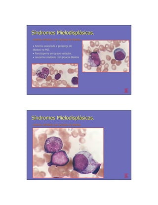 Síndromes Mielodisplásicas.
Anemia refratária com excesso de blastos.
       refratá

• Anemia associada a presença de
                     presenç
blastos na MO.
• Pancitopenia em graus variados.
• Leucemia mielóide com poucos blastos
            mieló




Síndromes Mielodisplásicas.
Anemia refratária com excesso de blastos.
       refratá
 