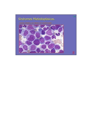 **
Síndromes Mielodisplásicas.
Anemia refratária com blastos em transformação.
       refratá                   transformação.
 