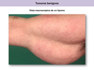 Tumores benignos
Vista macroscópica de un lipoma
 