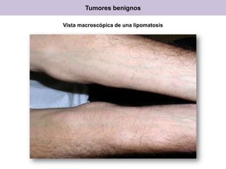Tumores benignos
Vista macroscópica de una lipomatosis
 