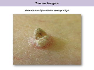 Vista macroscópica de una verruga vulgar
Tumores benignos
 