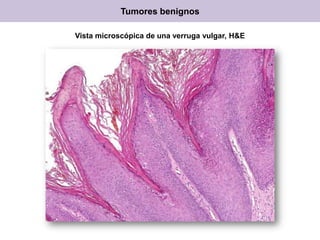 Vista microscópica de una verruga vulgar, H&E
Tumores benignos
 