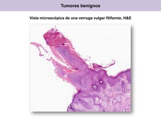 Vista microscópica de una verruga vulgar filiforme, H&E
Tumores benignos
 