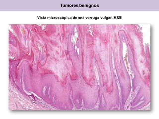 Vista microscópica de una verruga vulgar, H&E
Tumores benignos
 