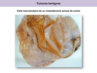 Vista macroscópica de un cistoadenoma seroso de ovario
Tumores benignos
 