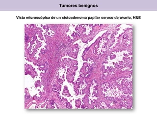 Vista microscópica de un cistoadenoma papilar seroso de ovario, H&E
Tumores benignos
 