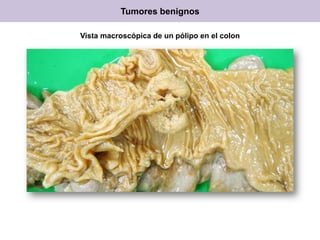 Vista macroscópica de un pólipo en el colon
Tumores benignos
 