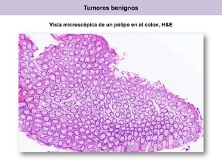 Vista microscópica de un pólipo en el colon, H&E
Tumores benignos
 