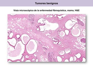 Vista microscópica de la enfermedad fibroquística, mama, H&E
Tumores benignos
 