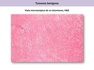 Vista microscópica de un leiomioma, H&E
Tumores benignos
 