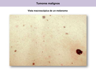 Tumores malignos
Vista macroscópica de un melanoma
 