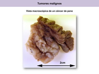 Tumores malignos
Vista macroscópica de un cáncer de pene
 