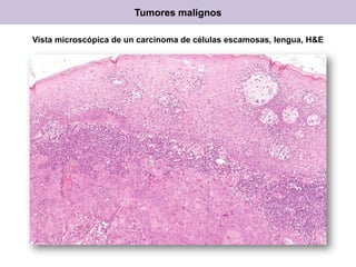 Vista microscópica de un carcinoma de células escamosas, lengua, H&E
Tumores malignos
 