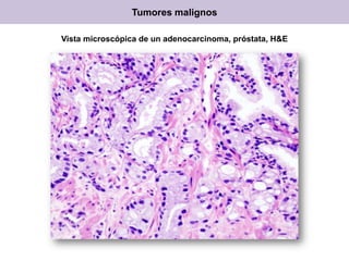 Vista microscópica de un adenocarcinoma, próstata, H&E
Tumores malignos
 