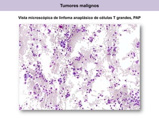 Tumores malignos
Vista microscópica de linfoma anaplásico de células T grandes, PAP
 