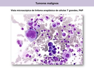 Tumores malignos
Vista microscópica de linfoma anaplásico de células T grandes, PAP
 