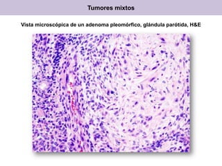 Vista microscópica de un adenoma pleomórfico, glándula parótida, H&E
Tumores mixtos
 