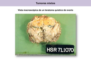 Vista macroscópica de un teratoma quístico de ovario
Tumores mixtos
 