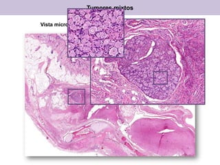 Vista microscópica de un teratoma maduro, ovario, H&E
Tumores mixtos
 