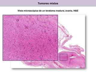 Tumores mixtos
Vista microscópica de un teratoma maduro, ovario, H&E
 