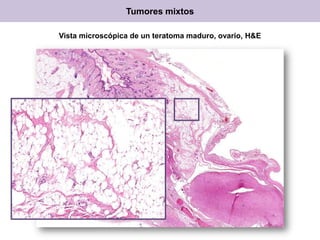 Tumores mixtos
Vista microscópica de un teratoma maduro, ovario, H&E
 