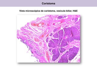 Coristoma
Vista microscópica de coristoma, vesícula biliar, H&E
 