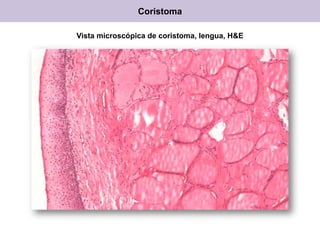 Coristoma
Vista microscópica de coristoma, lengua, H&E
 
