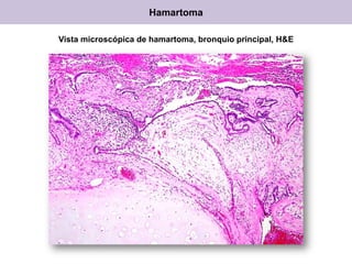 Vista microscópica de hamartoma, bronquio principal, H&E
Hamartoma
 