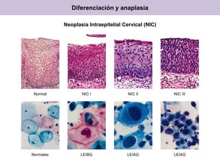 Diferenciación y anaplasia
Neoplasia Intraepitelial Cervical (NIC)
Normal NIC I NIC II NIC III
Normales LEIBG LEIAG LEIAG
 