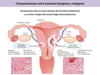 Comparaciones entre tumores benignos y malignos
Comparación entre un tumor benigno del miometrio (leiomioma)
y un tumor maligno del mismo origen (leiomiosarcoma)
 