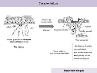 Características
Neoplasia maligna
Noxas que causan múltiples
alteraciones genéticas
Piel normal
Proceso de
transformación
(Rápido)
Tumor maligno:
Carcinoma epidermoide
▪ Limites mal definidos
▪ Invasión local
▪ Ulceración y necrosis
▪ Anaplasia y mitosis
▪ Invasión vascular
Carcinoma in situ
Invasión
Trombo tumoral
Vaso sanguíneo
 