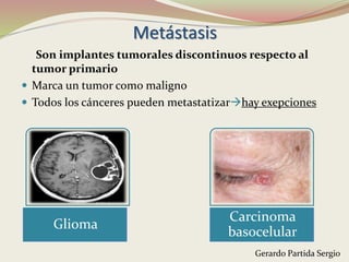 Metástasis
Son implantes tumorales discontinuos respecto al
tumor primario
 Marca un tumor como maligno
 Todos los cánceres pueden metastatizarhay exepciones
Glioma
Carcinoma
basocelular
Gerardo Partida Sergio
 
