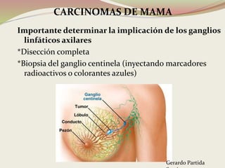 Importante determinar la implicación de los ganglios
linfáticos axilares
*Disección completa
*Biopsia del ganglio centinela (inyectando marcadores
radioactivos o colorantes azules)
CARCINOMAS DE MAMA
Gerardo Partida
 