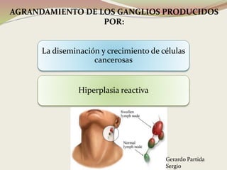 AGRANDAMIENTO DE LOS GANGLIOS PRODUCIDOS
POR:
La diseminación y crecimiento de células
cancerosas
Hiperplasia reactiva
Gerardo Partida
Sergio
 