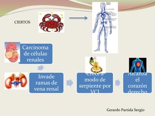 Carcinoma
de células
renales
Invade
ramas de
vena renal
Crece a
modo de
serpiente por
VCI
Alcanza
el
corazón
derecho
CIERTOS
Gerardo Partida Sergio
 