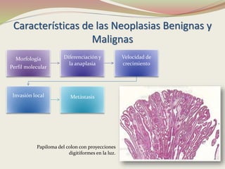 Características de las Neoplasias Benignas y
Malignas
Morfología
Perfil molecular
Diferenciación y
la anaplasia
Velocidad de
crecimiento
Invasión local Metástasis
Papiloma del colon con proyecciones
digitiformes en la luz.
 