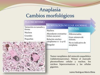 Anaplasia
Cambios morfológicos
PLEOMORFISMO
Variación en tamaño y
forma
Núcleos
Grandes
Pequeñas
MORFOLOGÍA NULEAR ANORMAL
Núcleos
Abundante cromatina
(tiñen oscuros)
Relación núcleo-
citoplasma 1:1 (1:4-6)
Irregular
MITOSIS
Diferenciados
Gran número de
mitosis.
No es indicativo de
neoplasia
Tumor neoplásico del músculo esquelético
(rabdomiosarcoma). Nótese el marcado
pleomorfismo celular y nuclear, los
núcleos hipercormaticos y las células
gigantes.
 