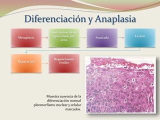 Diferenciación y Anaplasia
Metaplasia
Sustitución de un
tipo celular por
otro.
Asociada Lesión
Reparación
Regeneración
tisular
Muestra ausencia de la
diferenciación normal
pleomorfismo nuclear y celular
marcados.
 