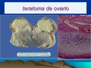teratoma de ovarioteratoma de ovario
 