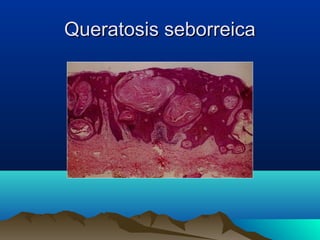 Queratosis seborreicaQueratosis seborreica
 