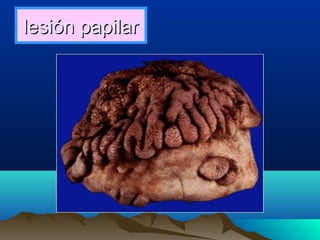 lesión papilarlesión papilar
 